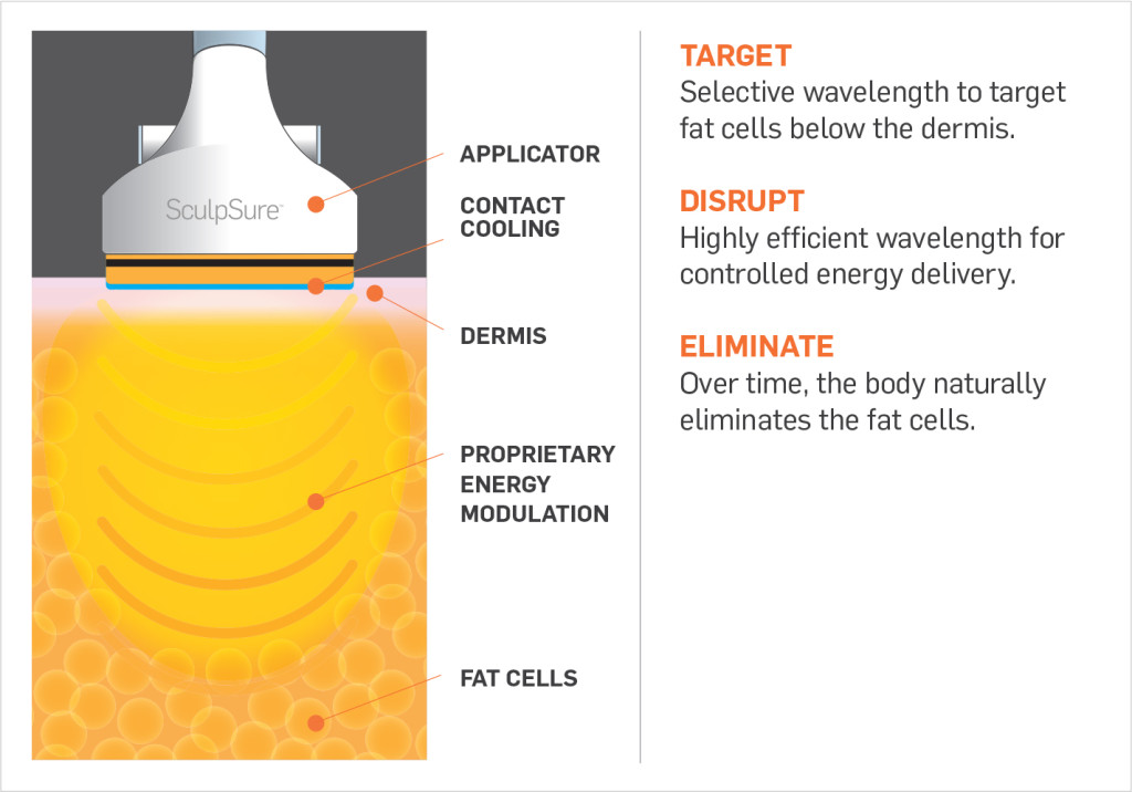 E! News Covers SculpSure