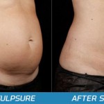 SculpSure_Before_And_After_Photos_Los_Angeles