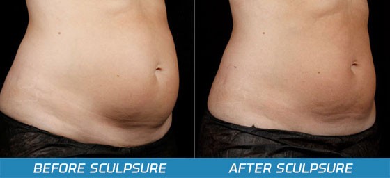 SculpSure Before and After Photos Lost Angeles