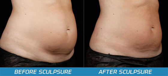 SculpSure Before and After Pictures - LaserTheFat.com