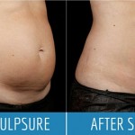 SculpSure-Before-After-Photo-Gallery