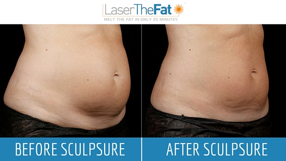 SculpSure Before and After Pictures - LaserTheFat.com