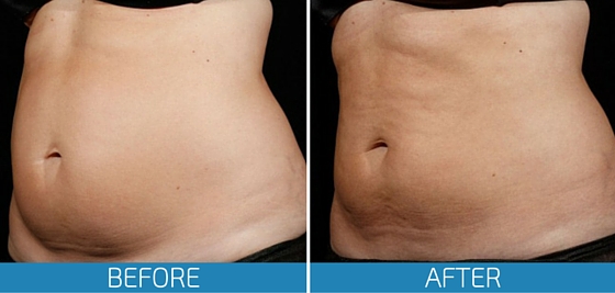 SculpSure-Before-After-Photo-Gallery